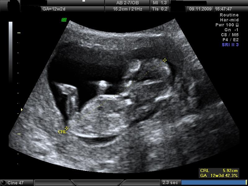 second dating scan
