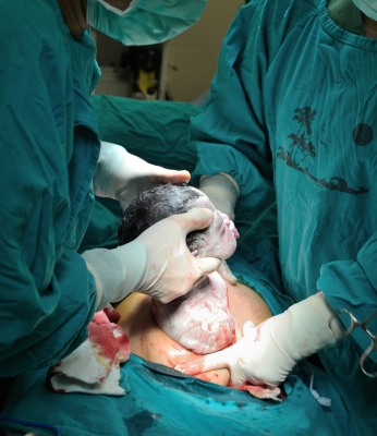 Caesarean section