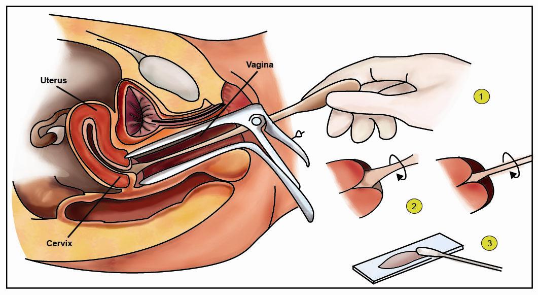 pap smear